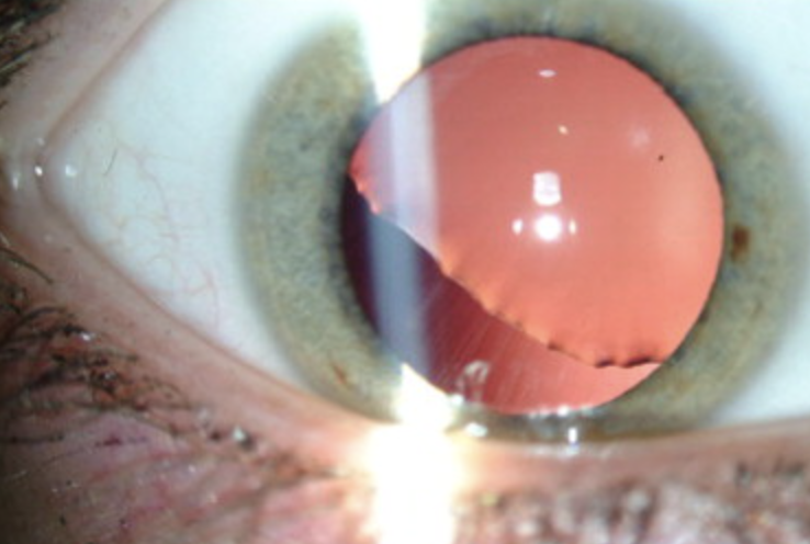 <p>One of the 4 Lens Abnormalities</p><ul><li><p>Condition where the <strong>lens becomes displaced</strong> from its normal position due to trauma, genetic disorders (like Marfan syndrome), or conditions like homocystinuria</p></li></ul><p></p>