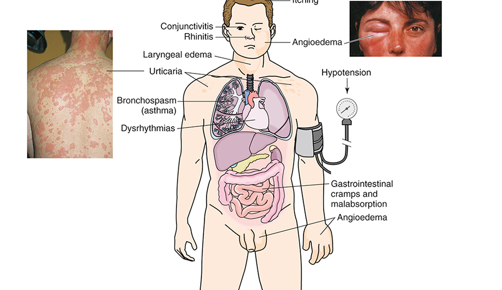 <p>What differentiated the type 1 hypersensitive reaction over the other?</p>