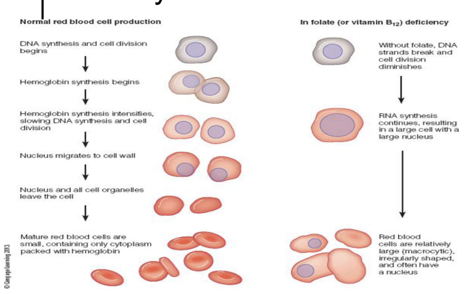 <p><strong><span>= when&nbsp;</span></strong><span>&nbsp;</span><strong>red blood cells (RBCs) are <em>larger than normal</em></strong><span><span> (“macro” = large) and often fewer in number.</span></span><br>-&nbsp;<span><span>Even though they’re big, they </span></span><strong>don’t function properly</strong><span><span> because they’re </span></span><strong>immature</strong><span><span> — they didn’t divide enough during development.</span></span></p><table style="min-width: 50px;"><colgroup><col style="min-width: 25px;"><col style="min-width: 25px;"></colgroup><tbody><tr><th colspan="1" rowspan="1"><p>Cause</p></th><th colspan="1" rowspan="1"><p>How it affects RBCs</p></th></tr><tr><td colspan="1" rowspan="1"><p><strong>Folate (vitamin B9) deficiency</strong></p></td><td colspan="1" rowspan="1"><p>Needed for DNA synthesis → fewer, larger RBCs</p></td></tr><tr><td colspan="1" rowspan="1"><p><strong>Vitamin B12 deficiency</strong></p></td><td colspan="1" rowspan="1"><p>Same mechanism (also causes neurological symptoms)</p></td></tr><tr><td colspan="1" rowspan="1"><p><strong>Alcoholism or liver disease</strong></p></td><td colspan="1" rowspan="1"><p>Interferes with RBC production</p></td></tr><tr><td colspan="1" rowspan="1"><p><strong>Certain drugs</strong> (e.g. chemotherapy)</p></td><td colspan="1" rowspan="1"><p>Inhibit DNA synthesis</p></td></tr></tbody></table><p></p>