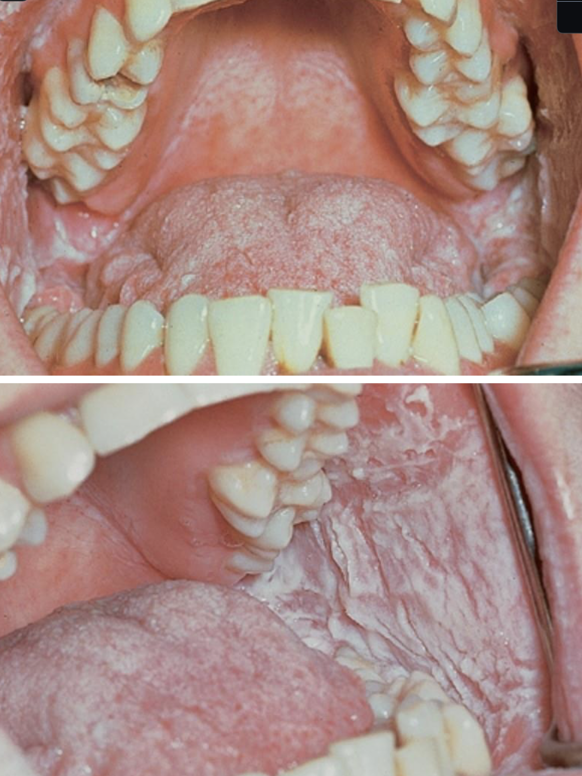<p>waxy fissured thick white plaques often bilateral hereditary </p>
