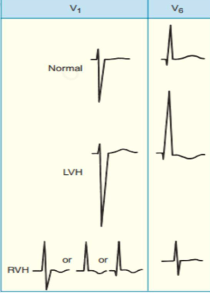 <p>lvh- st dep, prominent r</p>
