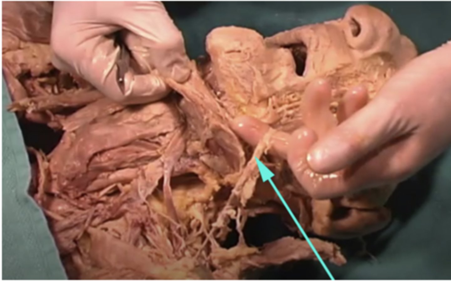 <p>What is the name of the structure as indicated by the arrow?</p><p>-glycoproteins</p><p>-external jugular vein</p><p>-internal jugular vein</p><p>-pectoralis major</p>