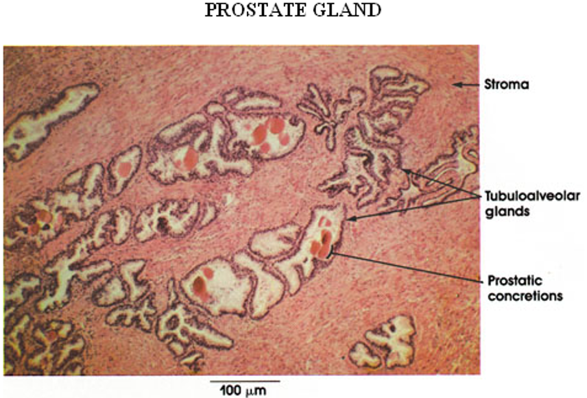 <p><strong>Prostate</strong></p><ul><li><p class=""><strong>Multiple secretory glands</strong></p></li><li><p class=""><strong>Corpora amylacea</strong> (round, eosinophilic concretions) often seen in gland lumens</p></li><li><p class="">Glands vary in size and shape</p></li></ul><p></p>