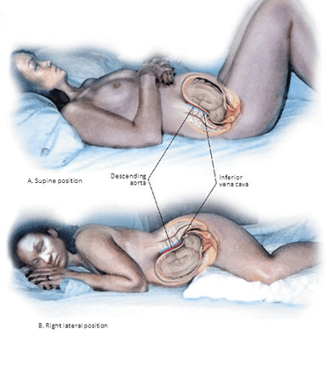 <p>compression of descending aorta and inferior vena cava by uterus w/ baby when patient is supine</p>