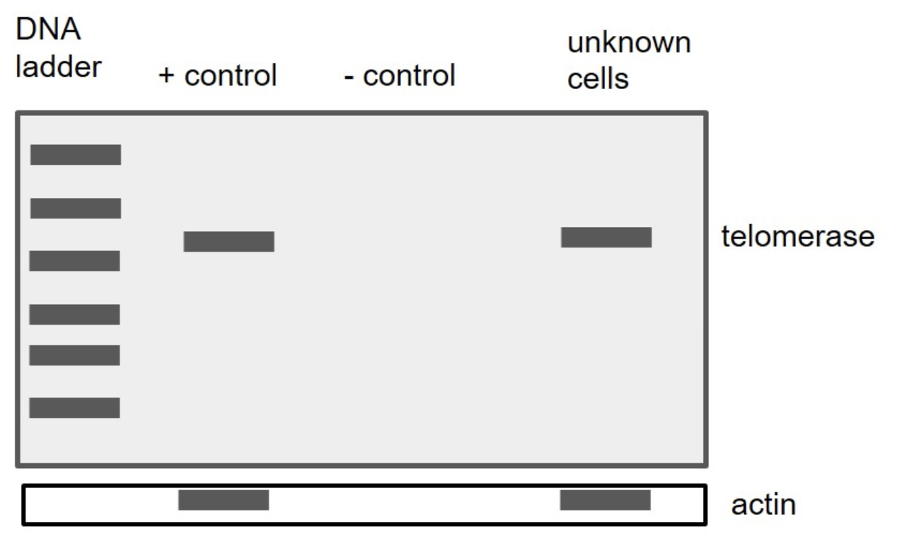 <p>You are trying to figure out what type of cells are in a sample you&apos;ve found. So, you decide to run a PCR with primers specific for the telomerase gene. You run correct/appropriate positive and negative controls (here, your negative control is water) for your PCR. You obtain these results after running your gel:</p><p></p><p>Based on these results, what could your unknown cells be? One or more may be correct, so choose all that apply.</p><ol><li><p>Choice 1 of 5:Hematopoietic (blood) stem cells</p></li><li><p>Choice 2 of 5:Embryonic stem cells</p></li><li><p>Choice 3 of 5:Heart muscle cells</p></li><li><p>Choice 4 of 5:Retina (eye) cells</p></li><li><p>Choice 5 of 5:Brain cancer cells</p></li></ol>