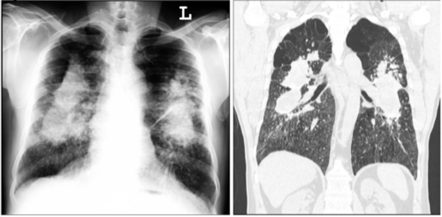 <p>Patient's occupation was mining and quarrying (worked in that field for 70+ years)</p>