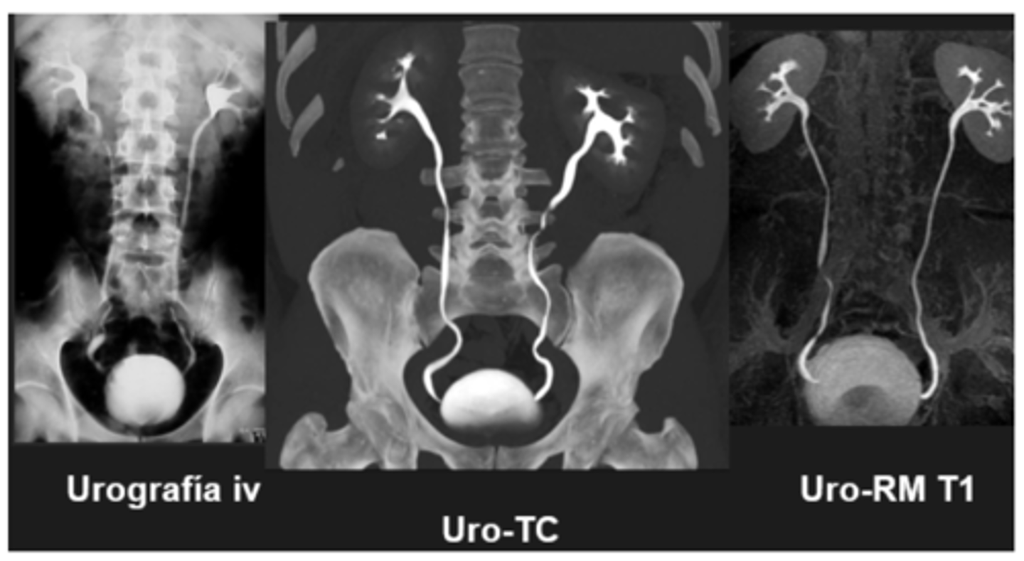 <p>Uro-TC → TAC con contraste en fase de eliminación.</p><p>Urografía IV → Radiografía antigua con bario como contraste.</p>
