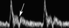 <p>smaller</p><p>anteromedial</p><p>ant to face</p><p>high resistance</p><p>*temporal tap</p><p>*supplies neck, face scalp (<strong>not brain</strong>)</p>