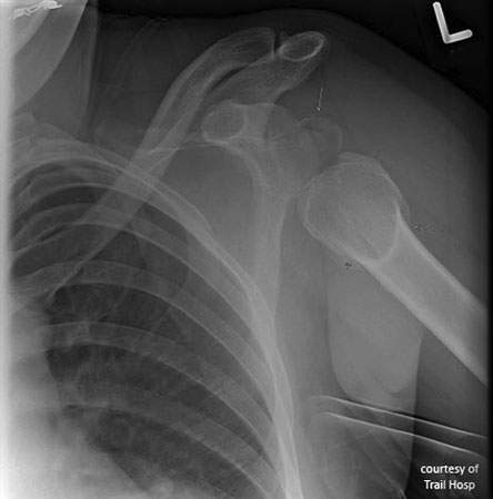 <p>Seizures, electrocution, or axial load in internal rotation.</p>