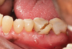 <p>results in <span style="color: red;">continuous drainage of pus</span> through the formed sinus tract</p><p>can develop following drainage of a parulis if the source of infection (commonly a necrotic pulp) is not removed</p><ul><li><p><strong>treatment:</strong></p><ul><li><p>the papule <span style="color: red;">may persist as a fibroma</span></p></li><li><p>the sinus tract will close when the <span style="color: red;">source of infection is eliminated</span></p></li></ul></li></ul><p></p>
