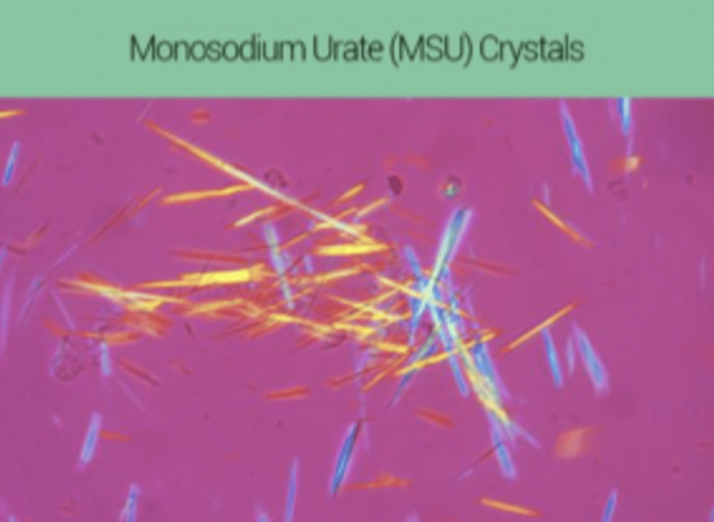<p>- Uric acid crystals</p><p>- Negative bifringement, GOUT</p><p>- Yellow when parallel to compensator ray</p>