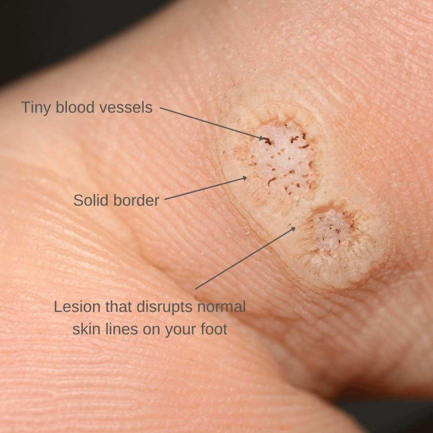 <p>PP: benign viral tumor<br>wart</p><p>E: HPV 16<br>HPV 18</p><p>CM:<br><u>common wart (verrucous vulgaris):</u></p><ul><li><p>solitary papule</p></li><li><p>irregular</p></li><li><p>scaly surface</p></li></ul><p><u>plantar wart (verrucous plantaris):</u></p><ul><li><p>weight-bearing areas on feet</p></li></ul><p><u>flat wart (verruca plana):</u></p><ul><li><p>multiple papules</p></li><li><p>flat-topped</p></li><li><p>broad-skin</p></li><li><p>colored</p></li></ul><p><u>veneral wart (candyloma acuminata):</u></p><ul><li><p>multiple/confluent papules</p></li><li><p>irregular surface</p></li><li><p>on genital mucosa</p></li></ul><p>TX:<br>NP:<br><strong>1st line: cryotherapy</strong><br>laser surgery</p><p>MX:<br><strong>1st line: topical salicylic acid</strong><br>intralesional bleomycin<br>topical fluorouracil<br>topical immunotherapy</p>