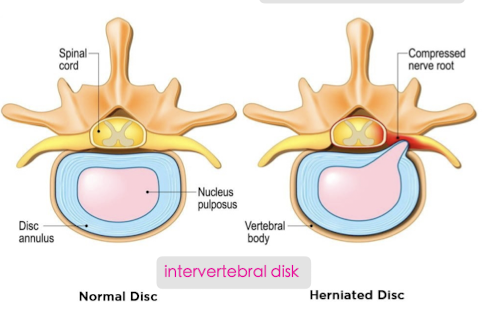 A slipped, ruptured, bulging disc 
can compress a nerve root  