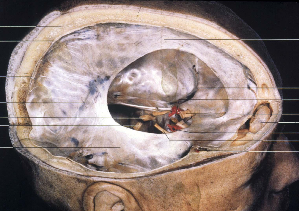 here you can see the tentorium, optic nerves, falx cerebri, stalk of pituitary (from behind the chiasm), internal carotid artery, cavernous sinus