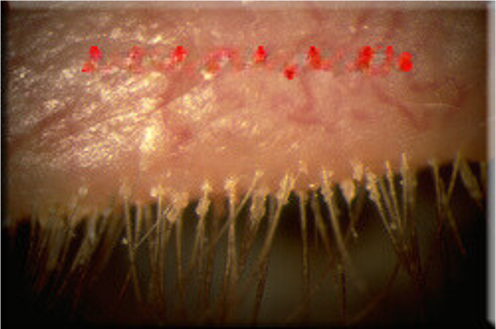 <p>chronic bilateral inflammation of lid margins</p>