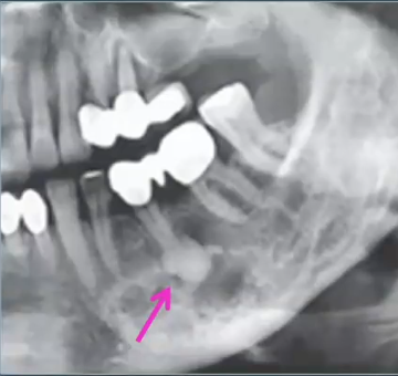 <p>history: middle-aged Africa-American woman, tooth is <strong>vital</strong> and <strong>asymptomatic</strong></p>