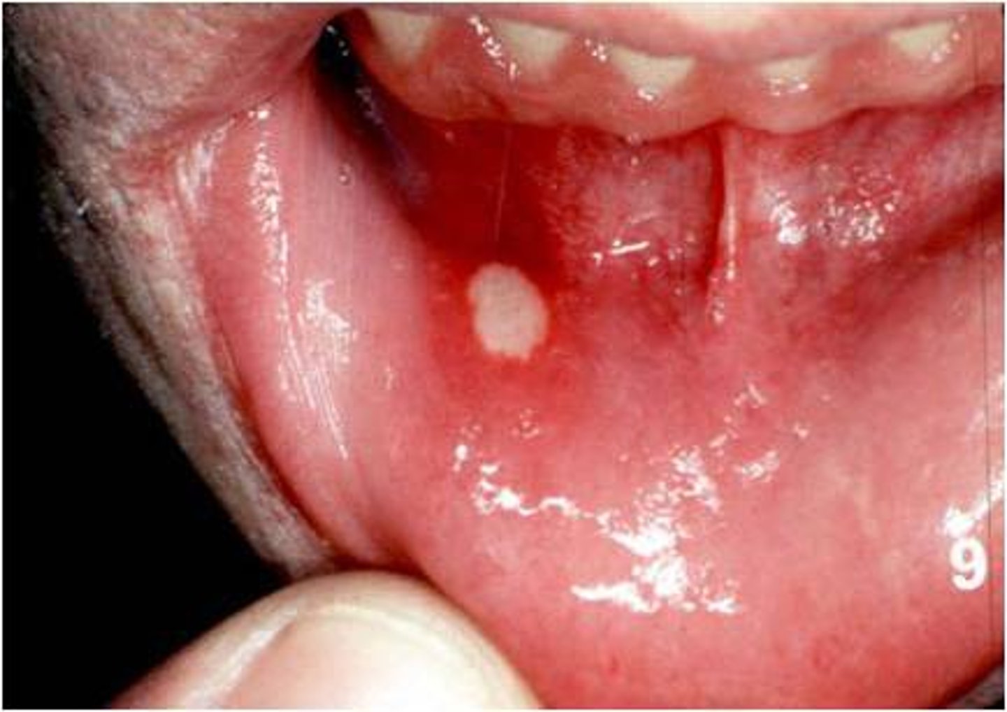 <p>-Recurring and painful, well-circumscribed with erythematous halo</p><p>-Located on unattached mucosa</p><p>-Stress, acidic, or trauma induced</p><p>-Incidence in smokers</p>