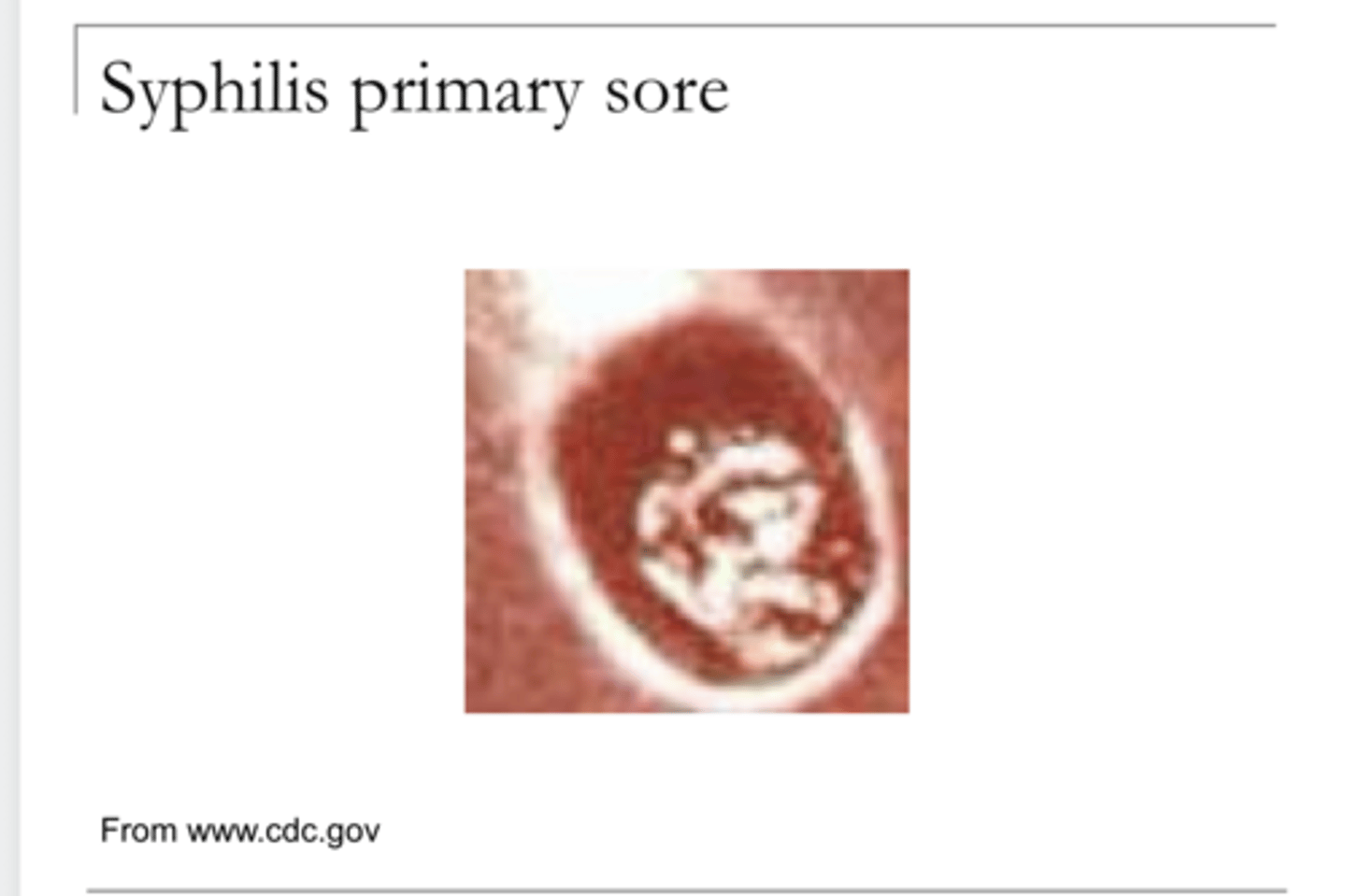 <p>Syphilis Primary Sore (Pic)</p>