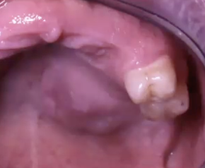 <p>Where might you find mucoepidermoid carcinoma?</p>
