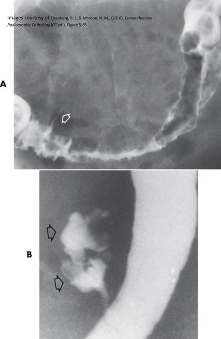 <p>The inflamed or infected form of diverticulosis, usually due to trapped fecal material.</p>