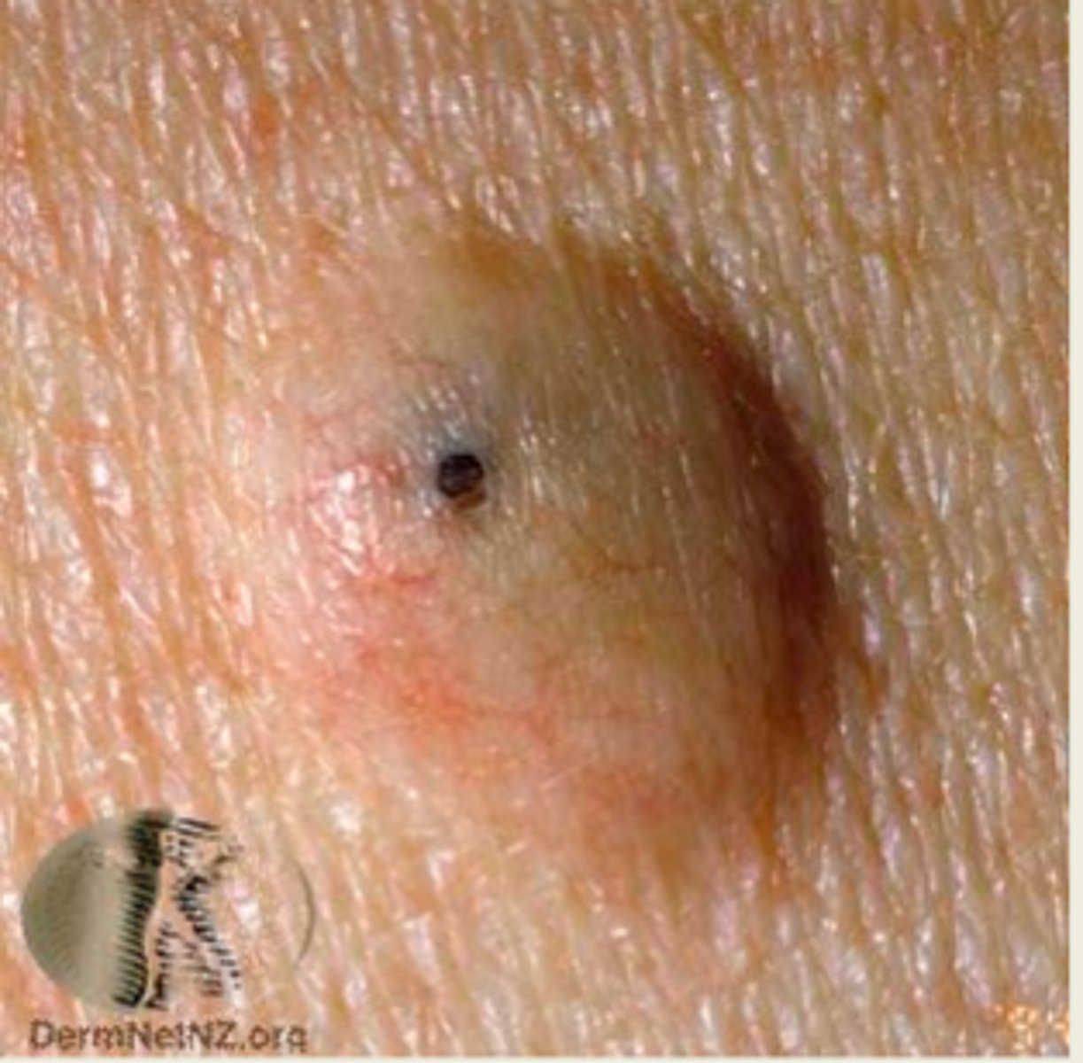 <p>developmental cyst of skin on head/neck</p>