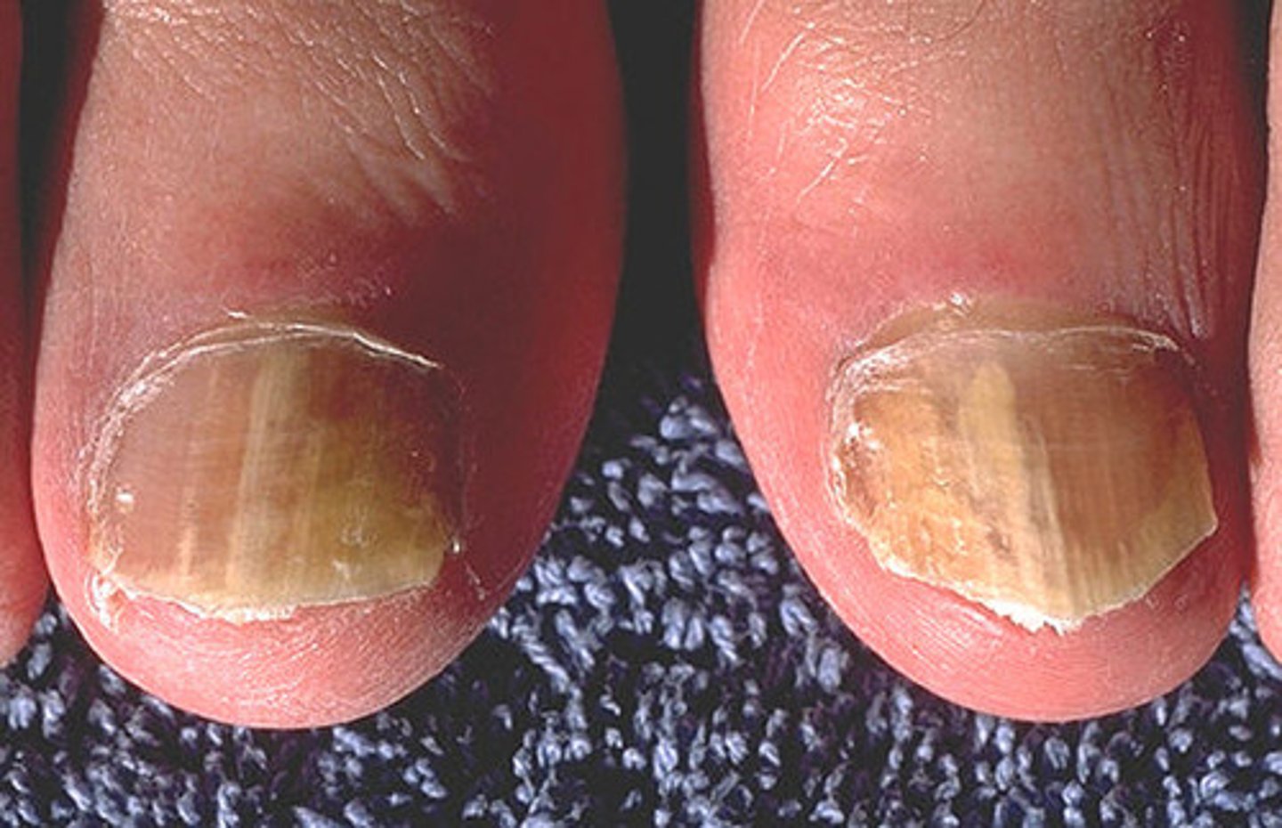 <p>the nail will become weak and yellowed and usually bigger than it was before the fungus started growing underneath the nail</p>