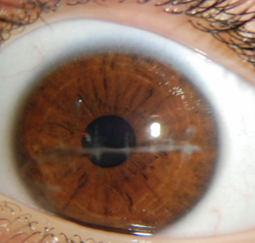 <p>One of the 6 Corneal Abnormalities</p><ul><li><p>Appears grayish white</p></li><li><p>Usually due to an old injury or inflammation</p></li></ul><p></p>