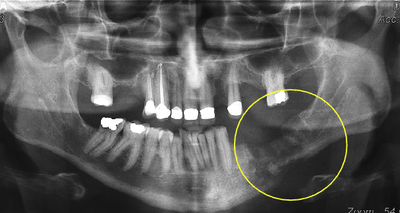 <ol><li><p>poorly defined </p></li><li><p>non-corticated </p></li><li><p>gradual transition to normal trabeculae </p></li></ol><p></p>