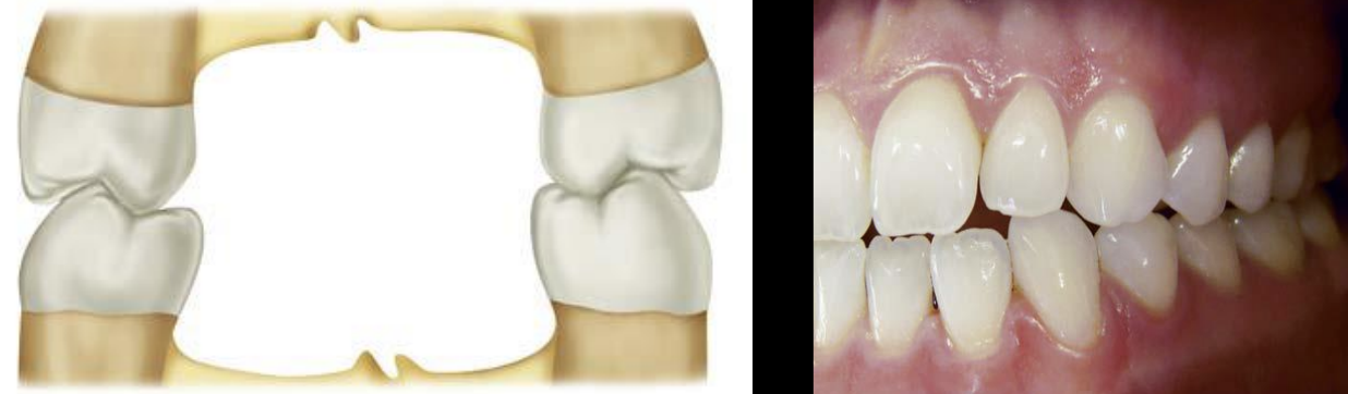 <p>Mandibular buccal cusps occlude along central fossa areas of maxillary teeth</p>