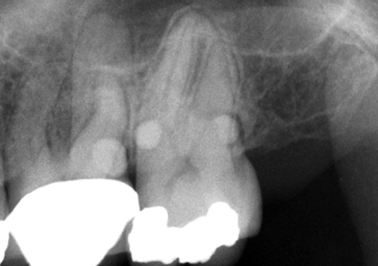 <p>4. Using Fig. 5.24, what would you call the enamel projections seen on the maxillary molars?</p><p>a. Enamel pearl</p><p>b. Enamel projection</p><p>c. Hypercementosis</p><p>d. Dens in dente</p>