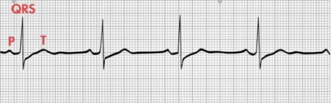 Contains 1 P wave for every QRS complex.