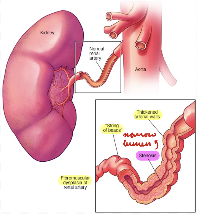 <p>Renal artery stenosis from connective tissue and muscle fibre proliferation</p><ul><li><p>10%</p></li><li><p>Mostly women < 50 years</p></li></ul><p></p>
