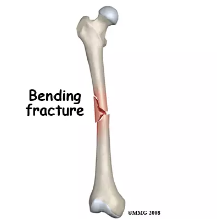 A bending fracture, also known as a flexural or tension fracture, occurs when a force is applied perpendicular to the long axis of a bone. This force causes the bone to bend, and if the stress is too great, it may result in a break.
