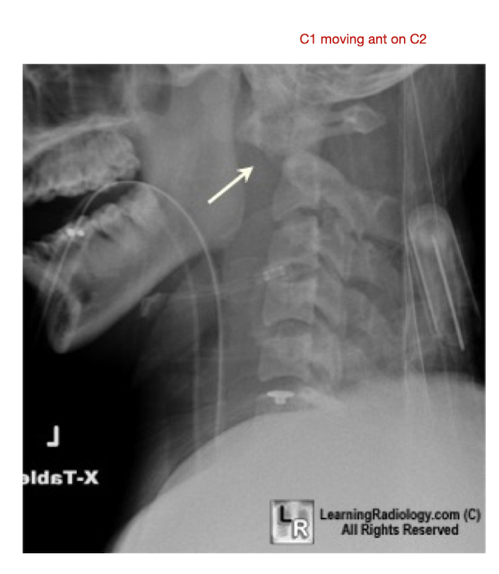 <ul><li><p>What is it?</p><ul><li><p>Erosion and narrowing of the facet jts</p></li></ul></li><li><p>Cause:</p><ul><li><p>Increased Lig Laxity </p><ul><li><p>Atlantoaxial Jt</p></li><li><p>Laxity of the Transverse Lig</p></li><li><p>Anterior Subluxation of C1 on C2</p></li></ul></li></ul></li></ul><p></p>