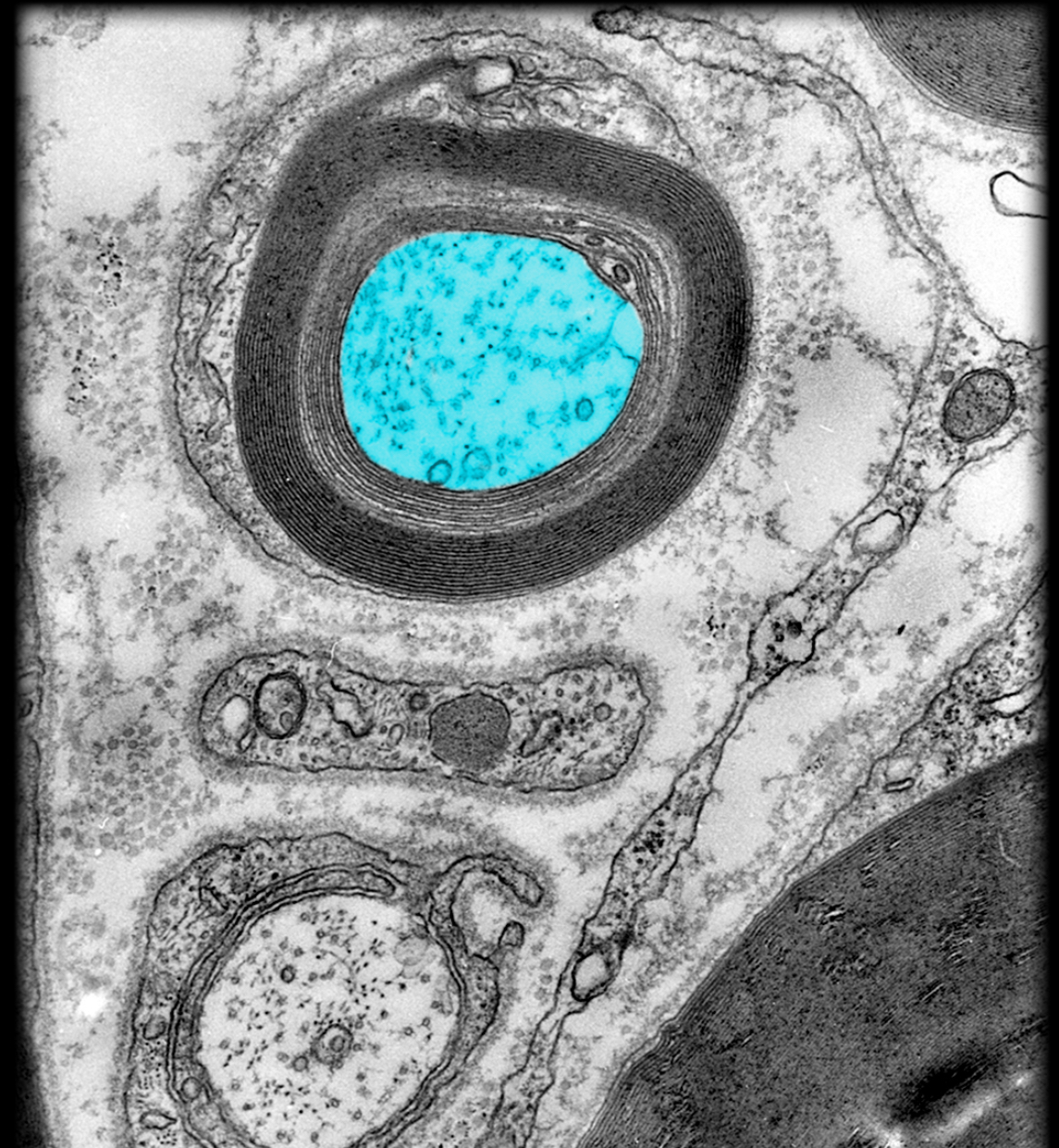 <h4 collapsed="false" seolevelmigrated="true"><strong>Location:</strong></h4><ul><li><p>Central nervous system (CNS)</p></li><li><p>Peripheral nervous system (PNS)</p></li></ul><h4 collapsed="false" seolevelmigrated="true"><strong>Description:</strong></h4><ul><li><p>Axon (usually 2 µm) wrapped by myelin sheath (layered spirals of myelin)</p></li></ul><h4 collapsed="false" seolevelmigrated="true"><strong>Function:</strong></h4><ul><li><p>Conveys efferent nerve impulses (i.e., away from soma)</p></li><li><p>Conveys information to other neurons or effectors</p></li><li><p>Myelin sheath increases speed of nerve impulse conduction</p></li></ul><h4 collapsed="false" seolevelmigrated="true"><strong>Comment:</strong></h4><ul><li><p>Nerve impulses travel faster (3-15 m/sec) in small myelinated axons than in unmyelinated axons of similar size (0.5-2.0 m/sec)</p></li><li><p>Myelinating cell is oligodendrocyte (CNS) or Schwann cell (PNS)</p></li><li><p>Aggregates of myelinated axons in CNS known as white matter</p></li></ul>