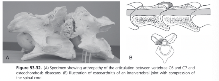 <p>Occurs in older horses and results from cervical osteoarthropathy</p>