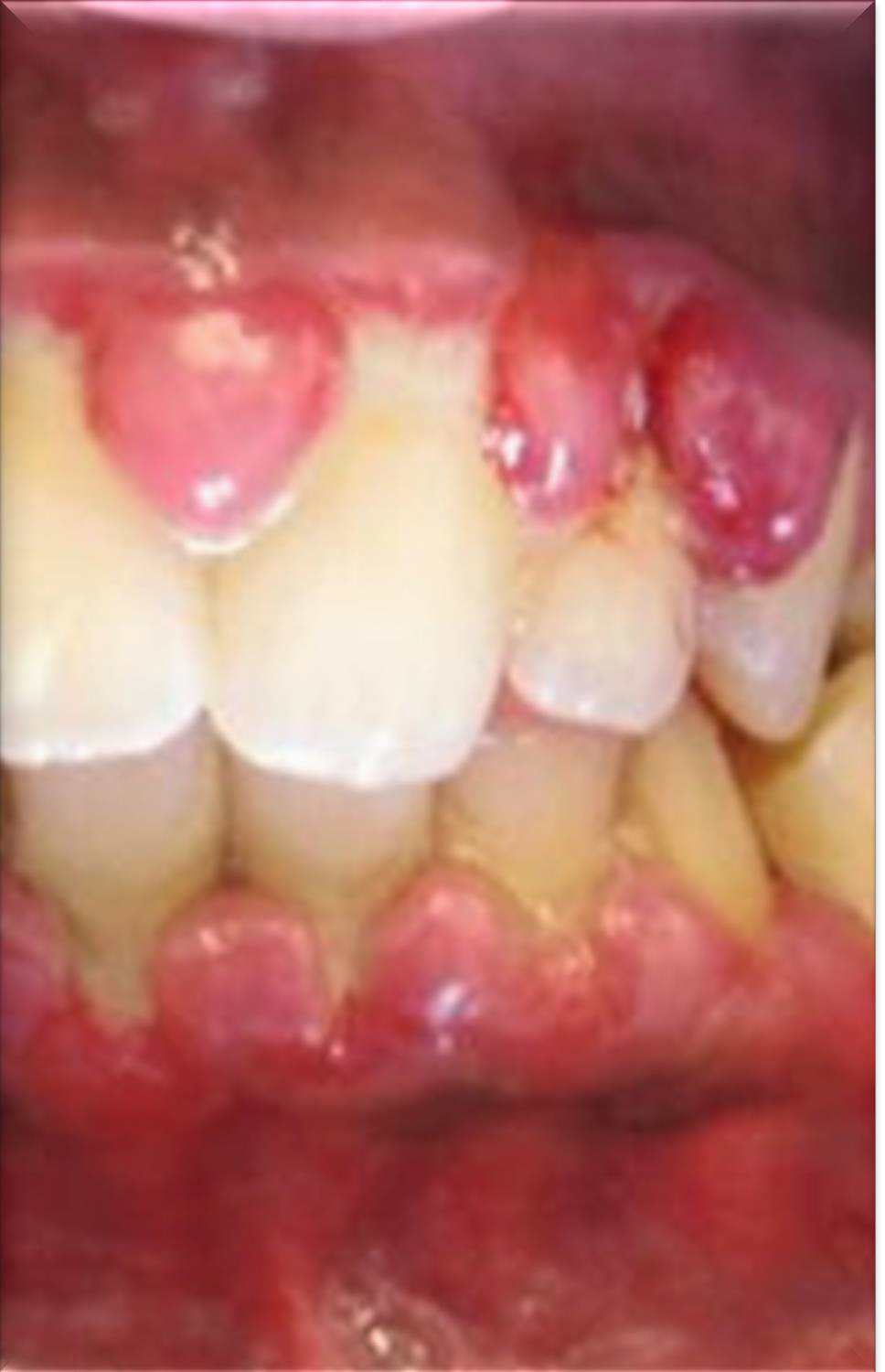 <p>What adverse effect can improper technique cause in inflamed gingiva?</p>