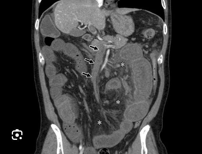 <p>Which abdominal emergency is associated with <strong>atrial fibrillation </strong>causing <strong>abdominal pain ‘out of proportion to examination’ </strong>assessed by <strong>CT angiography of the abdomen </strong>and treated with <strong>anticoagulation and emergent surgery?</strong></p>