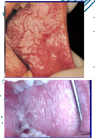 <p>-diffuse thick corrugated or velvety white plaques</p><p>-bilateral buccal mucosa: sometimes also ventral tongue, labial mucosa, soft palate, alveolar mucosa, floor of mouth, rarely also extraoral (nasal, esophageal, laryngeal, anogenital mucosa)</p>