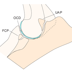 <ol><li><p>Radiologically: Triangular subchondral defect can be seen on medial aspect of humeral trochlea in craniocaudal projection. Sclerosis of medial condyle. </p></li><li><p>Surgical exploration of joint (arthroscopy) confirms definitive diagnosis when a flap is present.</p></li></ol><p></p>
