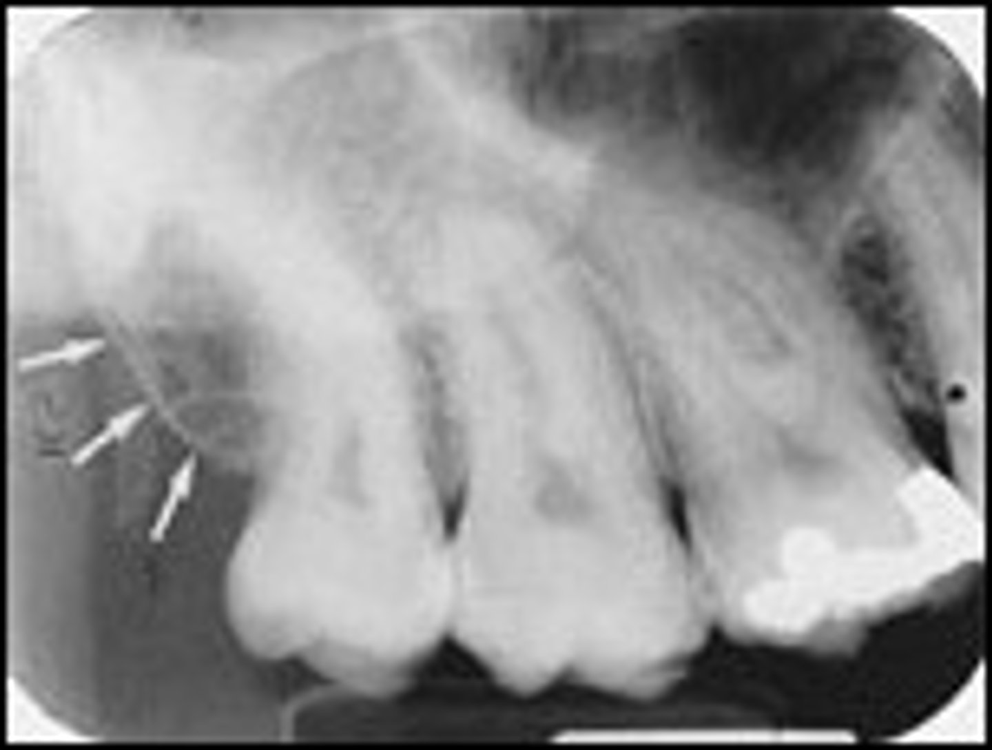 <p>What is the radiopaque structure seen here?</p>