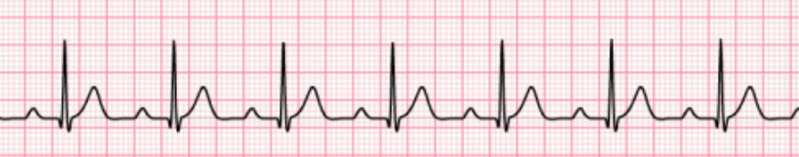 <p>Determine the A-V dysrhythmia (blocks):</p><ul><li><p>Prolonged PR interval (above 0.20 second)</p></li><li><p>Rate can occur at any sinus rate, usually 60-100 bpm</p></li><li><p>P waves are normal, precede every QRS</p></li></ul><p></p>