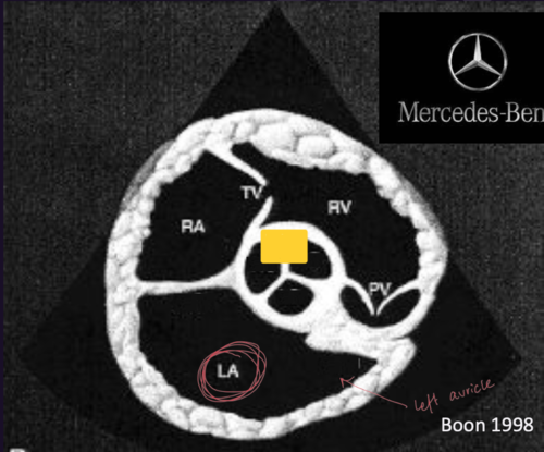<p>Right Parasternal Short Axis View&nbsp;</p>
