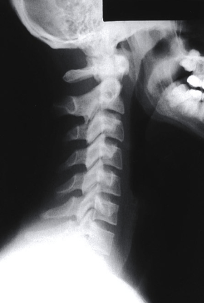 <p>which view is this?</p><p>a. Lateral</p><p>b. Oblique</p><p>c. PA</p><p>d. AP</p>