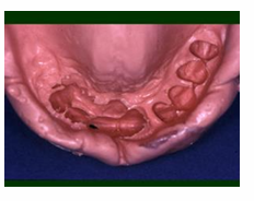<p>digital scans do not record the sulci very well which is why we don’t use them routinely for dentures</p>
