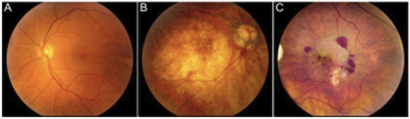 <p>Greatest risk factor is age. Damage/reduced RPE function leads to insufficient photoreceptor support, which leads to photoreceptor death. </p>