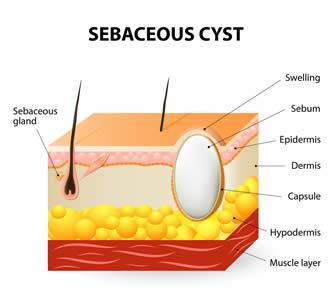 <p>AKA epidermal cyst, a slow growing non cancerous lump that develops from sebaceaous gland or hair follicle. cysts often filled with keratin, skin cells, lipids. can be problematic if they become infected, inflamed or interfere with daily life </p>