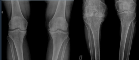 <p>Gonarthrosis </p><p> </p>