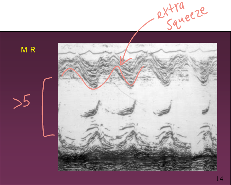 <ul><li><p>Dilated LA and LV (LV bigger than 5 cm)</p></li><li><p>LVVO hyperdynamic LV</p></li><li><p>Increased MV amplitude (D-E excursion) - related to increased volume</p></li><li><p>Early mid systolic closure of the aortic valve</p></li><li><p>RV enlargement</p></li></ul>
