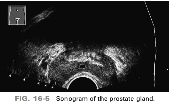 <p>hyperechoic foci are identified in which of the following regions of the prostate gland</p>